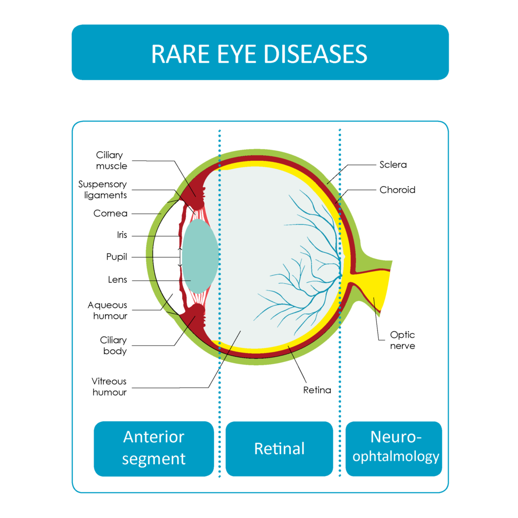 Rzadkie choroby oczu obejmują zaburzenia przedniego odcinka oka, siatkówki i nerwu wzrokowego